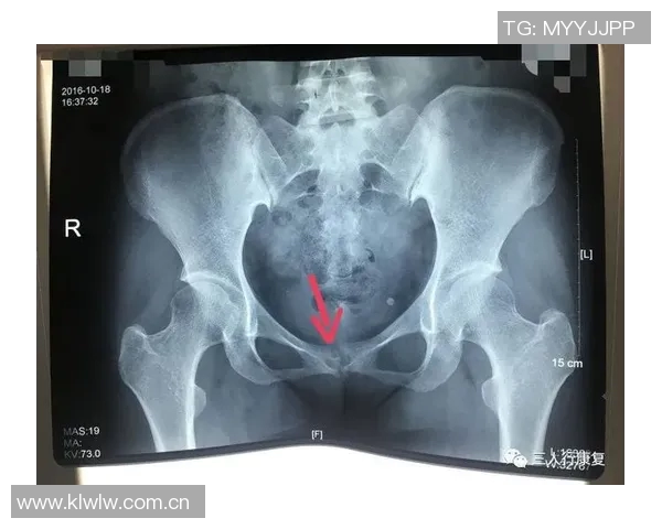医生解析耻骨炎对亚马尔的影响及其过度使用损伤的成因与后果